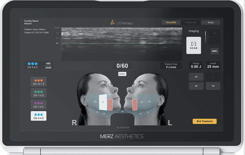One Month Since Introducing Ulthera Prime: What I Learned from Performing the Procedure Myself image 4