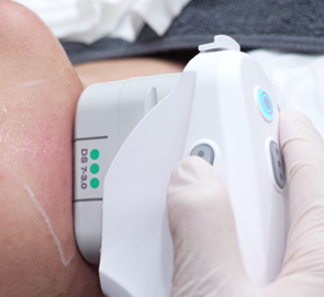 Ultherapy Prime: Facial Sagging Appears Differently Depending on the Area image 6