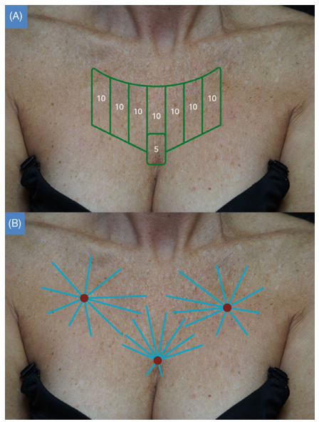 What Treatments Go Well with Ultherapy...? / Radiesse Collagen Booster image 3