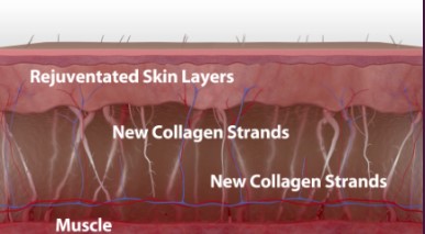 If You Didn’t See Results After Thermage, Be Sure to Read This (Must-Read for Those Who Feel Thermage Doesn’t Work) / Gangnam Sinsa Station Dermatology Clinic image 4