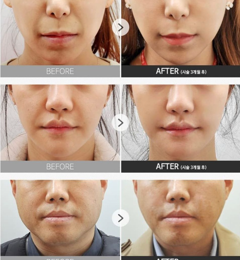 About Jamber Threads That Add Volume Instead of Filler / Gangnam Sinsa Station Dermatology Clinic image 4