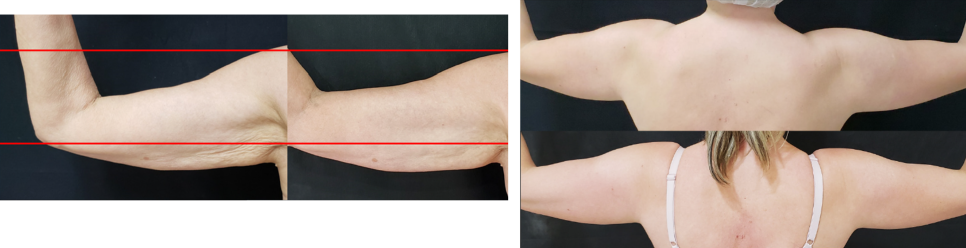 Collagen Volume Booster Radiesse (Part 3) / Gangnam Sinsa Station Dermatology image 2