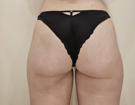 Lifton Dermatology Surpasses 1,200 Cumulative Radiesse Treatments image 7