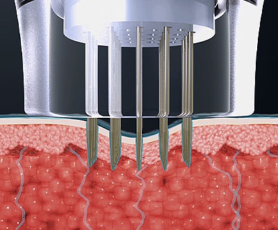 How to Reduce Pores image 3