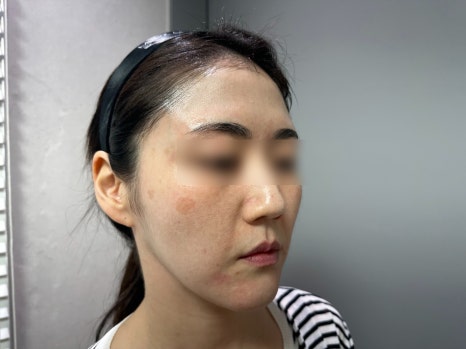 리쥬란과 물광주사를 하나로 합친 스킨부스터가 있다?(리쥬란 실제효과,르네힐러)/ 강남 신사동 피부과 관련 이미지 6