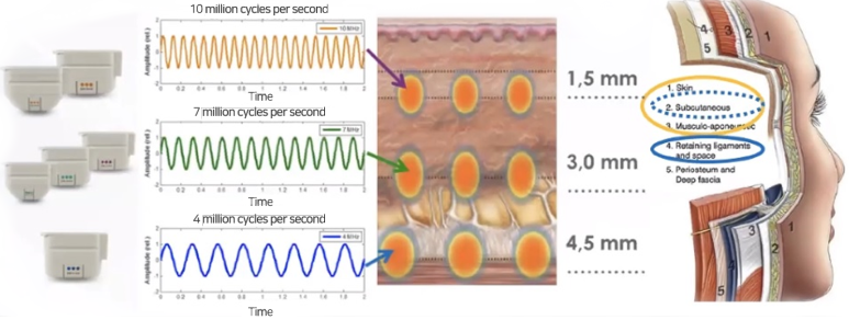 Lifting to Address Both Inner and Outer Skin Elasticity: Ultanium Lifting (Ulthera + Titanium) image 1