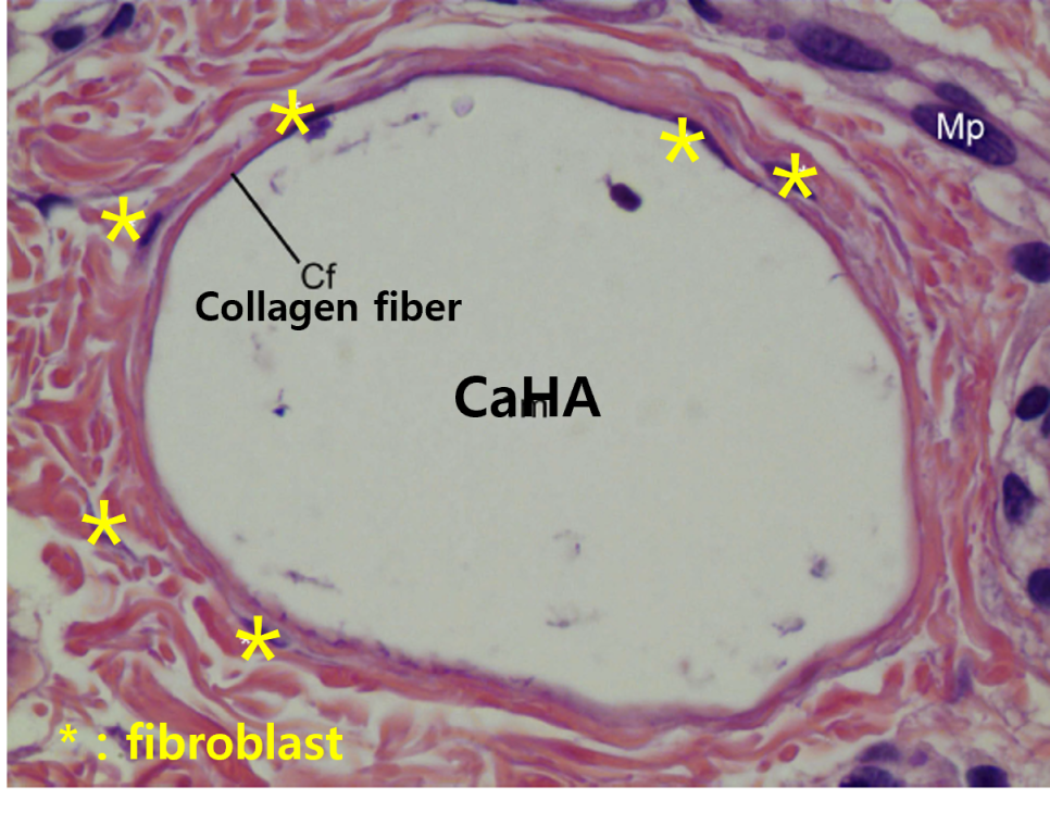 Radiesse... Filler or Booster? image 3
