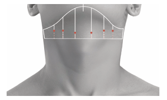 For Ultherapy Prime, precision targeting matters more than the number of shots. image 3