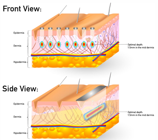 Sinsa SOFWAVE | Official Introduction at Lifton Dermatology Clinic image 8