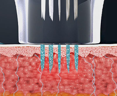 How to Reduce Pores image 5
