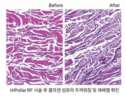 Lifton Dermatology Introduces TriLift ㅣ From Facial Muscles to Body Firmness image 5