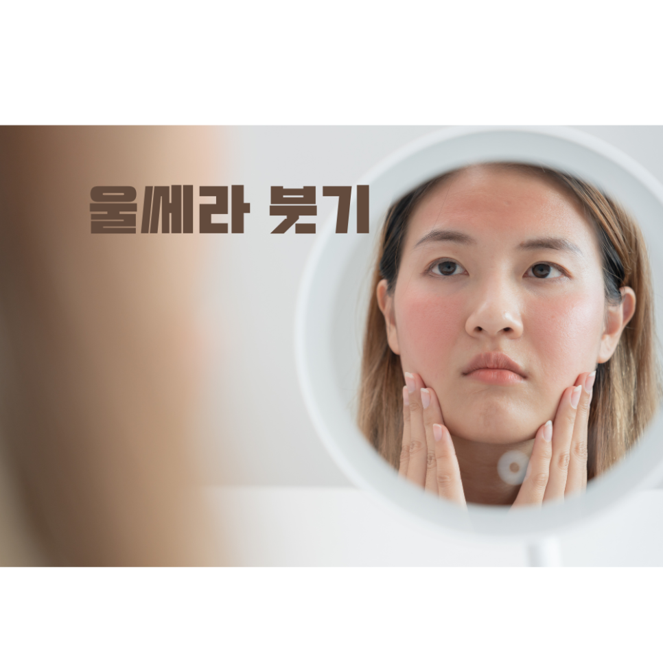 울쎄라 붓기 언제까지 가나요 관련 이미지 2