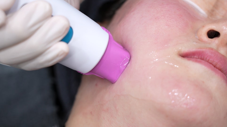 Sinsa Thermage FLX | LiftTone Dermatology Conducts Hands-on Training image 9