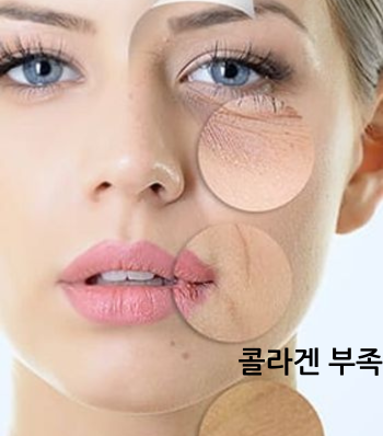 써마지효과 무작정 받지 마세요 관련 이미지 3