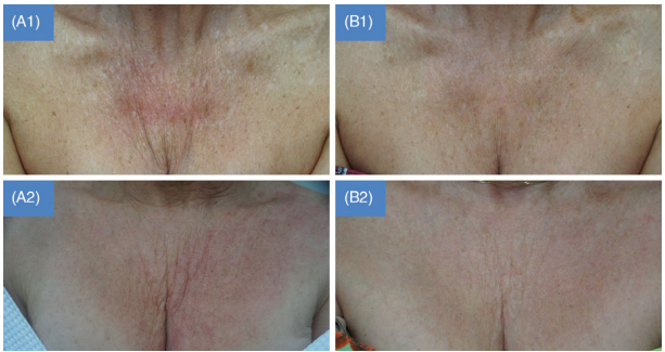 What Treatments Go Well with Ultherapy...? / Radiesse Collagen Booster image 5