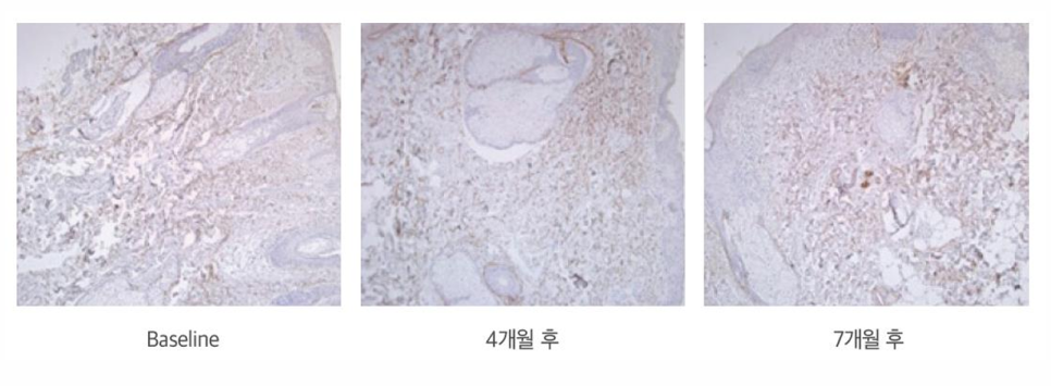 Natural Facial Volume: The Principles and Treatment Effects of Radiesse at Lifton image 6