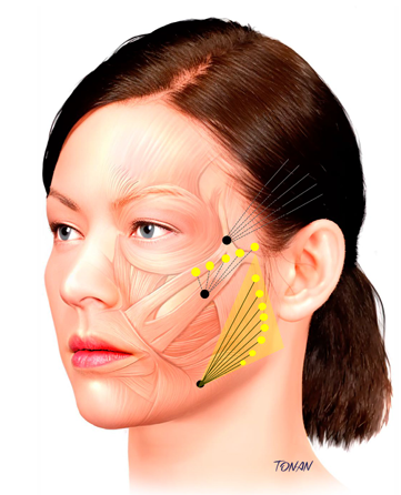 What Is Diclasy? Effects and Treatment Areas of the CaHA Collagen Booster image 10