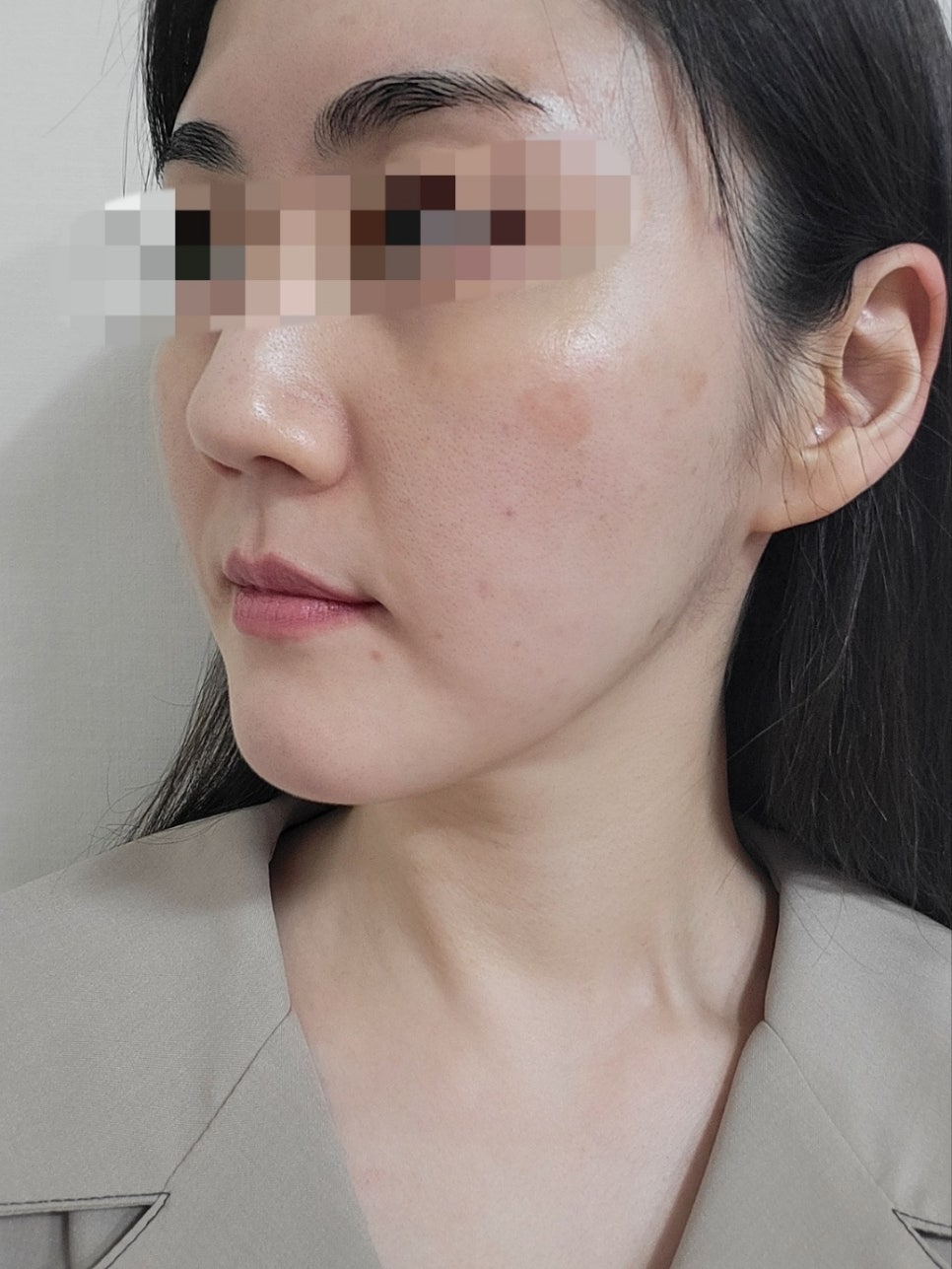 리쥬란과 물광주사를 하나로 합친 스킨부스터가 있다?(리쥬란 실제효과,르네힐러)/ 강남 신사동 피부과 관련 이미지 9