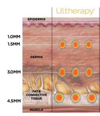 Why Full-Face Ulthera Is Needed image 2
