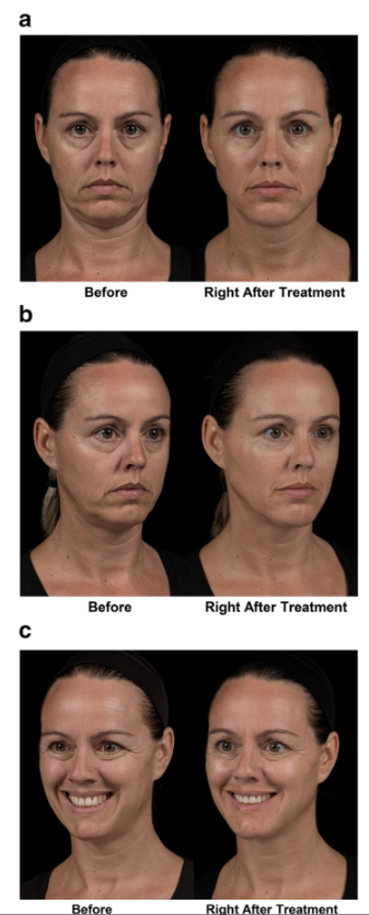 What Is MD Codes Filler? Why It Looks Naturally More Youthful image 10