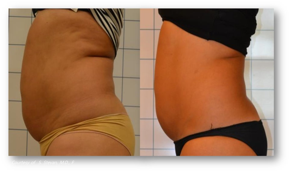 What Is Onda Lifting? Understanding Its Principles and Effects image 5