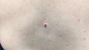 블랙헤드는 왜 생기는 걸까?(없에는 방법, 홈케어, 감별 질환) 관련 이미지 7