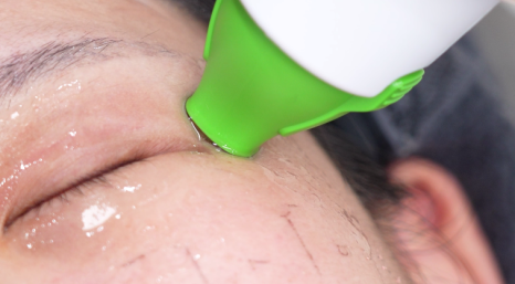 Thermage: A Scientific Method for Restoring Skin Elasticity with Radio Frequency image 9