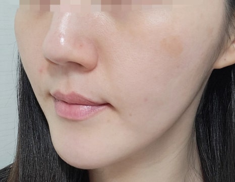 리쥬란과 물광주사를 하나로 합친 스킨부스터가 있다?(리쥬란 실제효과,르네힐러)/ 강남 신사동 피부과 관련 이미지 15