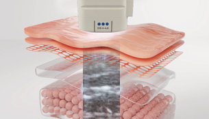 Ultherapy Prime: Facial Sagging Appears Differently Depending on the Area image 2