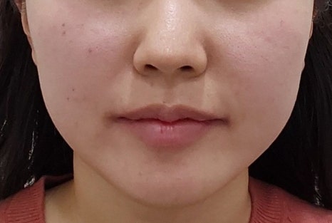 인모드와 같은듯 다른 온다리프팅/ 신사역 피부과 관련 이미지 6