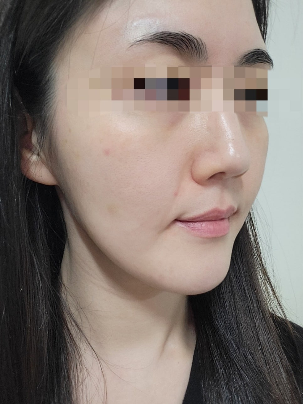 리쥬란과 물광주사를 하나로 합친 스킨부스터가 있다?(리쥬란 실제효과,르네힐러)/ 강남 신사동 피부과 관련 이미지 13