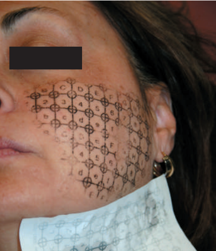 If You Didn’t See Results After Thermage, Be Sure to Read This (Must-Read for Those Who Feel Thermage Doesn’t Work) / Gangnam Sinsa Station Dermatology Clinic image 5