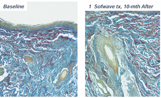 Sinsa SOFWAVE | Official Introduction at Lifton Dermatology Clinic image 6