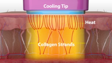 If You Didn’t See Results After Thermage, Be Sure to Read This (Must-Read for Those Who Feel Thermage Doesn’t Work) / Gangnam Sinsa Station Dermatology Clinic image 3