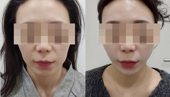 울써마지, 같이 하면 얼굴에 너무 강하지 않을까? 관련 이미지 6