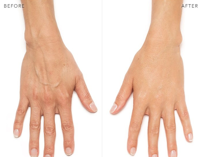 Radiesse for Improving Wrinkles on the Back of the Hands, and Its Nodule Side Effects image 2