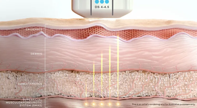 A Complete Guide to Ultherapy Prime Results: Key Points Analyzed Directly by a Dermatology Specialist image 5