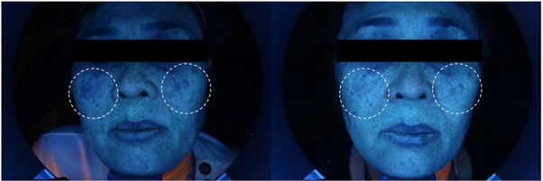 Lifting That Can Replace Ulthera and InMode: TION Lifting (Titanium + ONDA Lifting) image 4