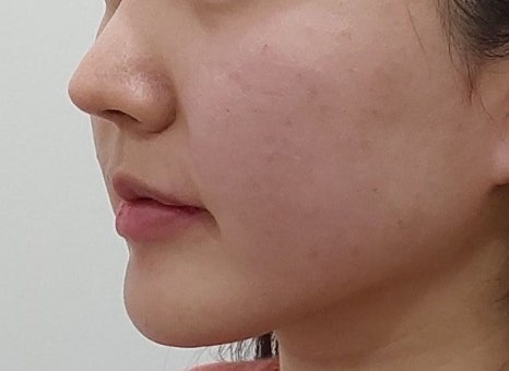 인모드와 같은듯 다른 온다리프팅/ 신사역 피부과 관련 이미지 7