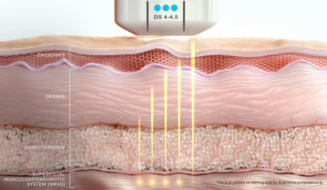 For Ultherapy Prime, precision targeting matters more than the number of shots. image 7
