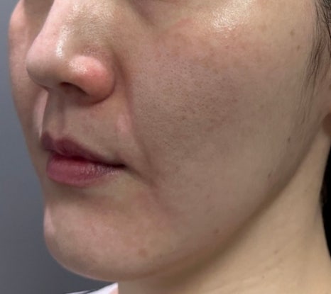 리쥬란과 물광주사를 하나로 합친 스킨부스터가 있다?(리쥬란 실제효과,르네힐러)/ 강남 신사동 피부과 관련 이미지 14