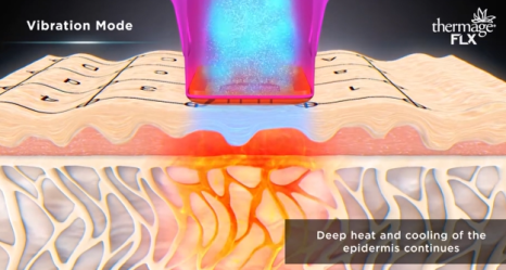 Thermage: A Scientific Method for Restoring Skin Elasticity with Radio Frequency image 4