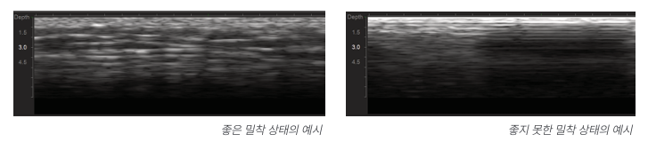 One Month Since Introducing Ulthera Prime: What I Learned from Performing the Procedure Myself image 7