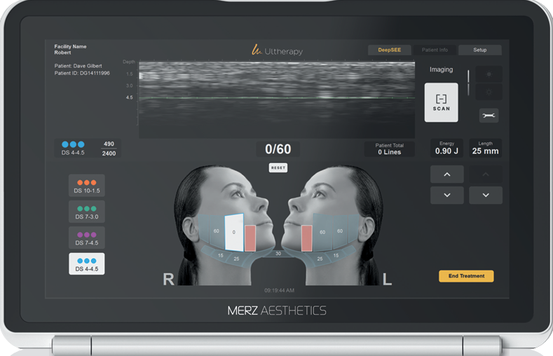Ulthera Prime Sets a New Standard in Lifting Procedures image 5