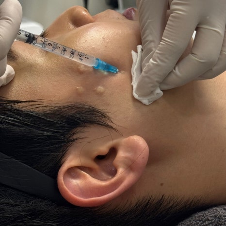 Gangnam Skin Booster: A Customized Solution for Each Skin Condition, Explained by a Dermatology Specialist image 11