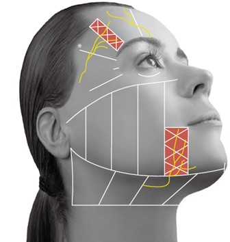 Ultherapy Prime: Facial Sagging Appears Differently Depending on the Area image 1
