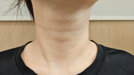 목 주름에 효과있는 시술 4가지 소개합니다/ 강남 신사역 피부과 관련 이미지 2