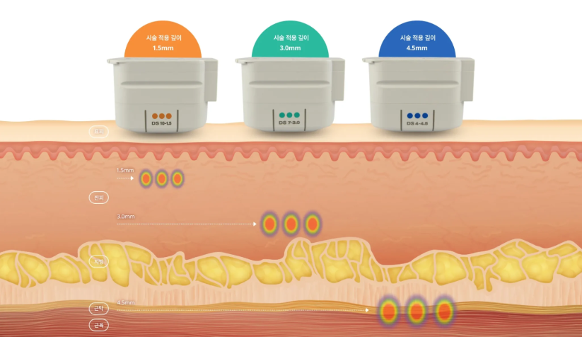 Sinsa Ulthera Prime — See the Core Differences from Thermage at a Glance image 2