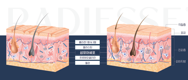 Why the Effects of Radiesse Should Be Viewed Differently from Fillers image 4