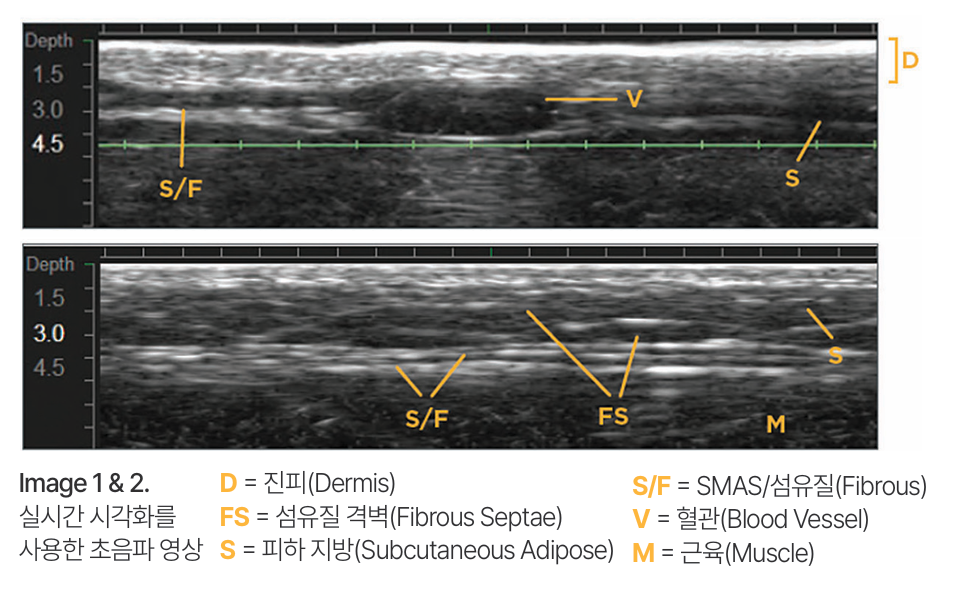 What Has Changed in the Effects and Pain of Ultherapy Prime? image 6